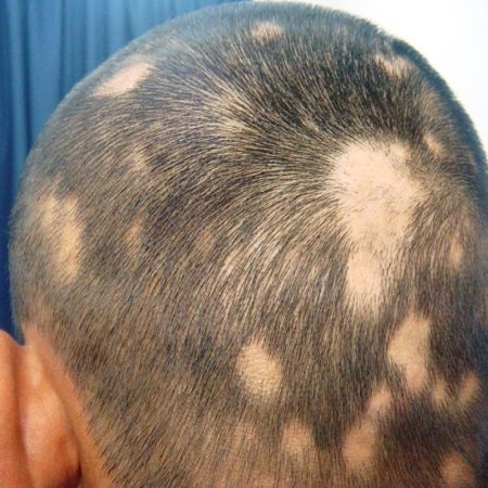 Alopecia-areata