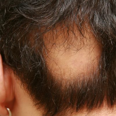 IMG_9709-1-Hair-loss-lesions-sqaure