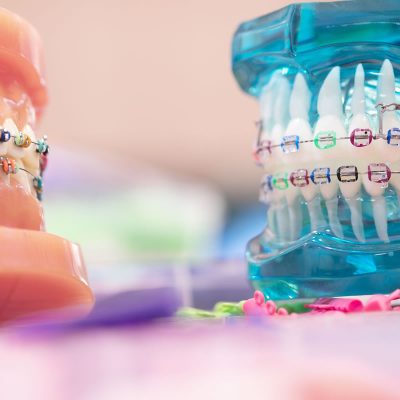 orthodontic-options